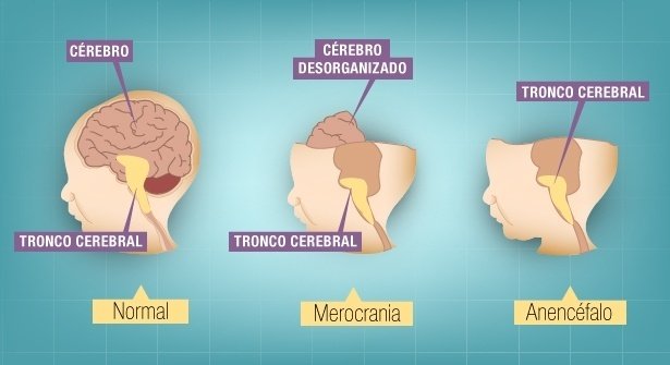 Justiça autoriza interromper gravidez de feto anencéfalo