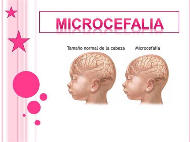 Saúde Municipal descarta caso de microcefalia