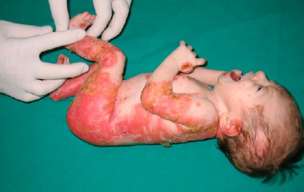 Epidermólise Bolhosa é tema da Tribuna Livre na Câmara