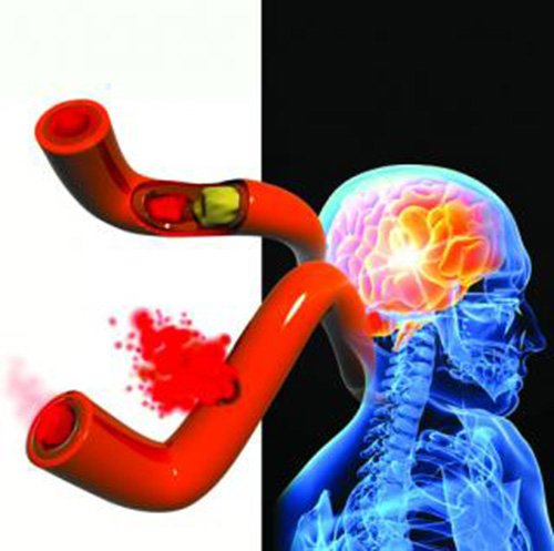 Hospital baiano pode ser 4º do mundo a reverter sequelas de AVC com cirurgia