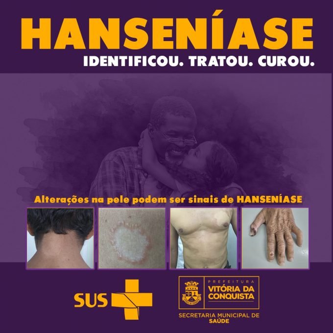 Janeiro Roxo alerta para o combate e prevenção da Hanseníase