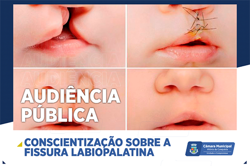 Em audiência pública, Câmara discute conscientização da fissura labiopalatina na segunda-feira, 20 em audiência pública