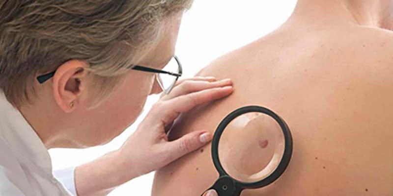 Pacientes com diagnóstico de câncer de pele participarão na Bahia de estudo mundial para vacina contra o doença