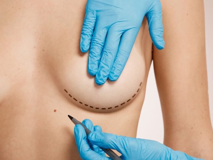 Crescimento de mamoplastia no Brasil reacende debate: beleza, segurança e retirada de implantes